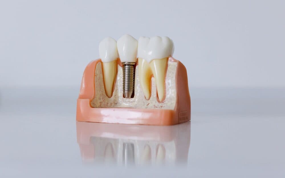 A dentist showing a patient a dental implant model