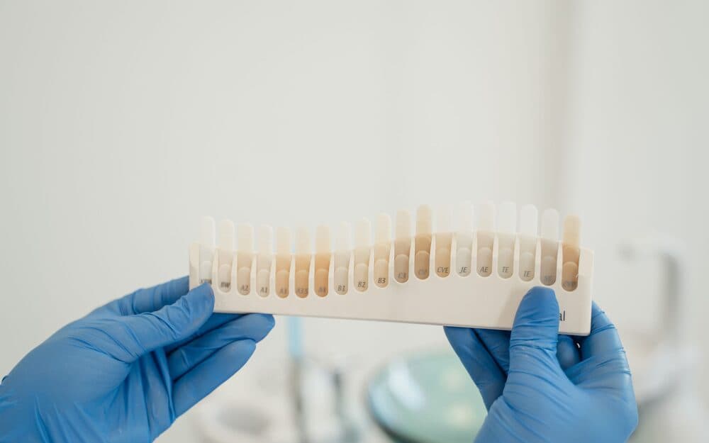 A dental shade guide being matched against a patient's teeth